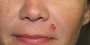 The cancer usually presents as a single reddish or purple lump on a part of the skin that is often exposed to. Squamous Cell Carcinoma Diagnosis Skin Cancer And Reconstructive Surgery Center