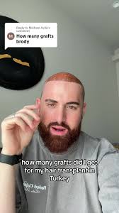 Hair Transplant: Understanding Chemical Cut On Hair