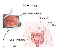 Image of Colonoscopy procedure