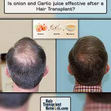 Pin On Hair Loss Treatments