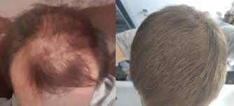 We did not find results for: How Often To Microneedle For Hair Loss It Depends Studies Photos