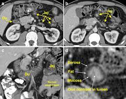 Coeliac Disease Ct Radiology At St Vincent S University Hospital