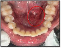 Image result for Sialoadenitis