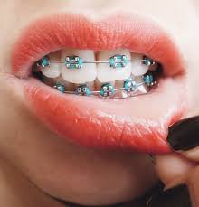 Black And Light Purple Braces Pin On Braces Color Ideas