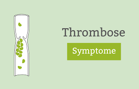Nach medizinwissenschaftlichen standards erstellt und geprüft. Thrombose Anzeichen Symptome Thrombosezeichen Erkennen Pflege De