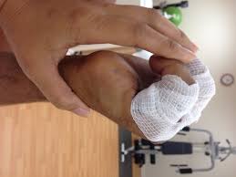 Image result for Hand Injury