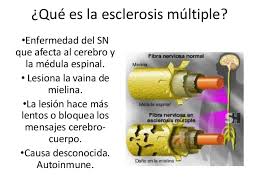 La esclerosis múltiple (em) es una enfermedad crónica y de momento sin cura del sistema nervioso central. Que Es La Esclerosis Multiple