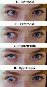 Strabismus Or Crossed Eyes Medical Knowledge Vision Therapy Eye Health