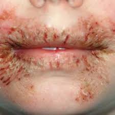 Clinical presentations vary from acute. Wet Wipes Linked To Contact Dermatitis In Children Mdedge Dermatology