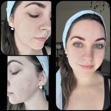 OUR MANDELIC PEEL JOURNEY. A DAY BY DAY ACCOUNT