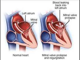Insuficienta mitrala este un defect valvular care constă în închiderea incompletă în sistolă a cuspelor valvei mitrale de la inimă. InsuficienÈ›a MitralÄƒ