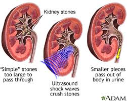 Kidney Stones Lithotripsy Discharge Information Mount Sinai New York