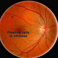 A new floater can be a sign of, what we most commonly fear is a retinal detachment. Floaters Flashes Retina Associates Of St Louis