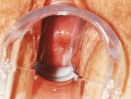 Image result for Vaginal Pooling