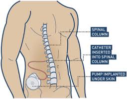 Image result for Intrathecal Pump