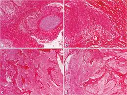 Can be quite large or small. Microscopic Images Of Resected Tumors A Immature Teratoma Of The Download Scientific Diagram