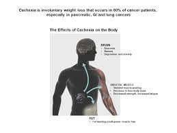 Image result for Cachexia in Cancer