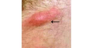 Image result for chancroid