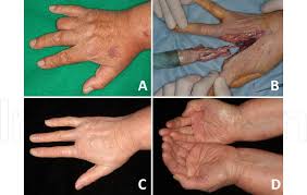 Image result for Acral lentiginous melanoma nail