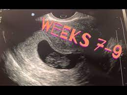 Was worried but found out it was quite common. 7 9 Weeks Pregnant Spotting Youtube