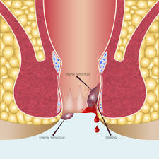 Hemorrhoids are abnormally enlarged veins at or near the anus. 5 629 Best Hemorrhoids Images Stock Photos Vectors Adobe Stock