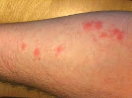 Image result for bedbugs bites
