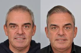 Image result for hair transplant