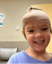 I cracked my head open, 7 stitches. They were more painful th3n the open  head wound