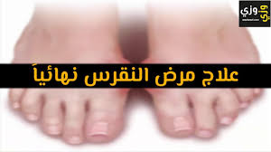 أهم علاج مرض النقرس نهائيا Youtube