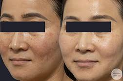 Image result for Melasma calycinum