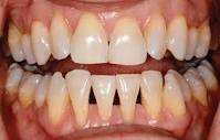 Treating The Black Triange With The Bioclear Method - Oral Health ...