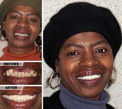 Click on each image to see a enlarged version in more detail. Brooklyn Affordable Dentures Full Or Partial Dental Denture Repair