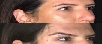 Foxy Eyes Arviv Medical Aesthetics Spot the difference | foxy face beauty an eyebrow story. foxy eyes arviv medical aesthetics