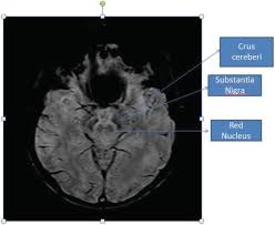 Related online courses on physioplus. Neuroimaging In Parkinson Disease Intechopen