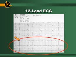We did not find results for: Essential 12 Lead Interpretation Ppt Download