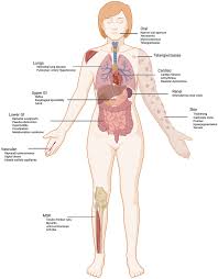 Educational image placeholder: lung GI and internal organ involvement in systemic sclerosis