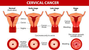 The first sign may be minor, but the second could be major discomforts. Cervical Cancer Causes Symptoms Signs Treatment