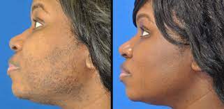 Sarah mess offers safe and effective permanent laser hair removal in columbia, md. Laser Hair Removal Center For Cosmetic Surgery Medispa