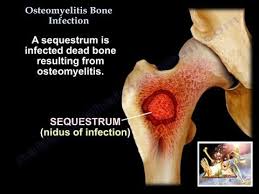 Image result for Osteomyelitis