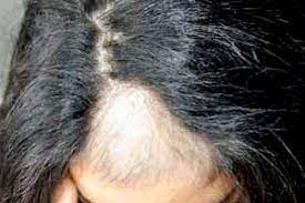 La perte de cheveux n'a pas la même signification chez un homme ou une femme, chez un adulte ou un enfant . Perte De Cheveux Chez La Femme A Geneve Centre Dermatologie Cornavin