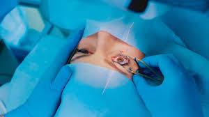 Smile laser eye surgery eliminates. The Untold Truth Of Lasik Surgery