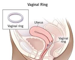 Image of Vaginal rings for contraception