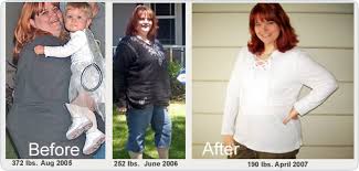 At a year from surgery (such as the gastric sleeve), weight loss success will depend on the changes made during this time. Before After Pictures Testimonials Gastric Bypass Before After Testimonials After Obesity Surgery San Francisco California