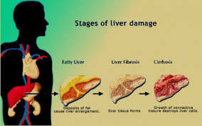 Fast Ways To Lower Elevated Liver Enzymes Naturally High Liver Enzymes Lower Liver Enzymes Elevated Liver Enzymes