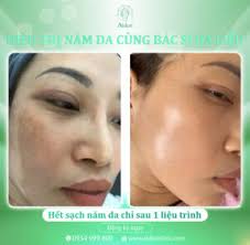 Điều trị nám da với công nghệ Picosecond Laser