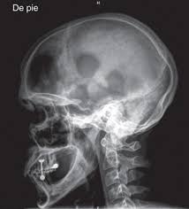 Manifestaciones Osteoarticulares De Las Histiocitosis Del Adulto Sciencedirect