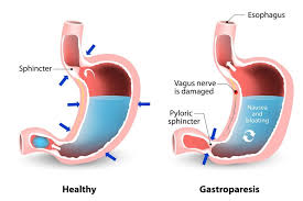 Oct 30, 2019 · how long does it take to work? Lpr Treatment The Supreme Therapy Guide Refluxgate