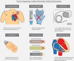 A pacemaker is a small device that's placed under the skin in your chest to help control your heartbeat. Leadless Pacemakers Reduce Risk Of Device Related Infection Review Of The Potential Mechanisms Sciencedirect