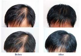 Is biotin good for receding hairline? Vogue Manlin Best Faster Hair Regrowth Spray Serum Ampoules Products For Frontal Baldness Receding Hairline Black Hair That Work Buy Hair Regrowth Products Hair Regrowth Ampoules Hair Regrowth Serum Product On Alibaba Com