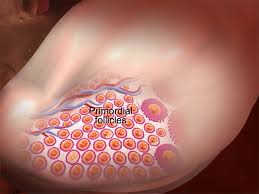 But any of the symptoms below could be an indication of ovarian cancer if they are frequent, worsening, or unusual and last longer than two weeks. 5 Facts About The Ovaries And Ovarian Cancer